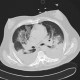 Bronchopneumonia, bilateral, pleural effusion: CT - Computed tomography